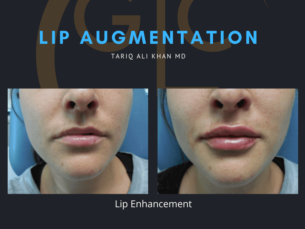 Gentle Care Laser Tustin & Long Beach Before and After picture - Lip Augmentation